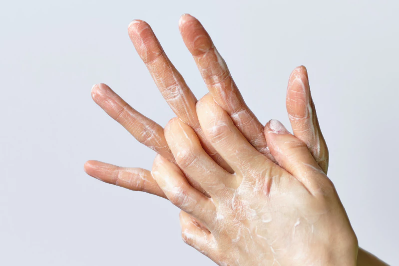 cara mengatasi kulit tangan mengelupas karena detergen