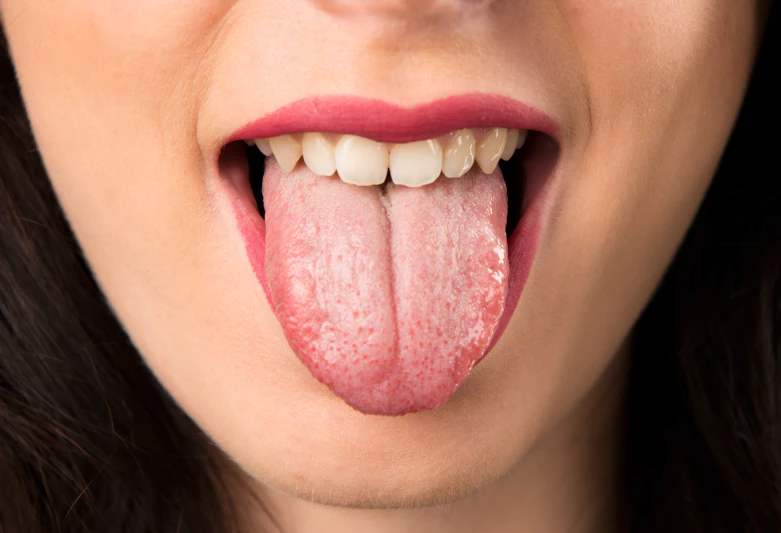 penyebab lidah putih